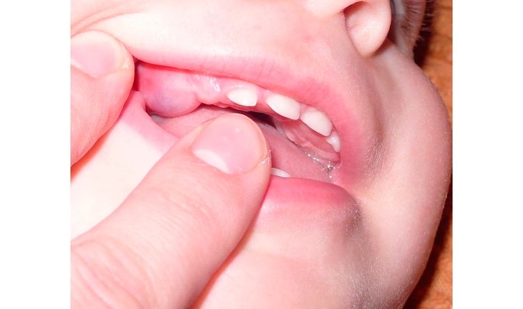 Прорезывание зубов или травмы синяя десна у ребенка