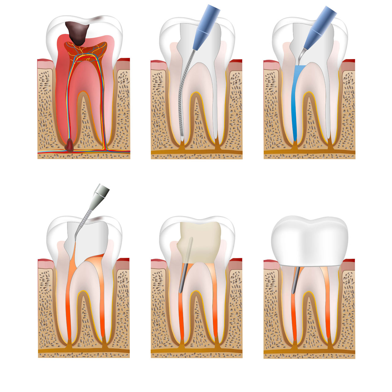 Может ли болеть зуб после удаления нерва и чистки каналов, особенно при надавливании