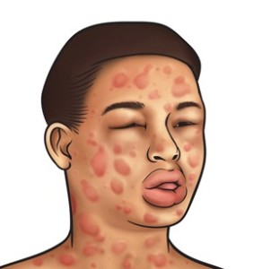 рисунок аллергической реакции после укуса пчелы на лице человека