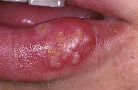 Пузырьковые язвы герпетический стоматит у детей. Лечение и симптомы