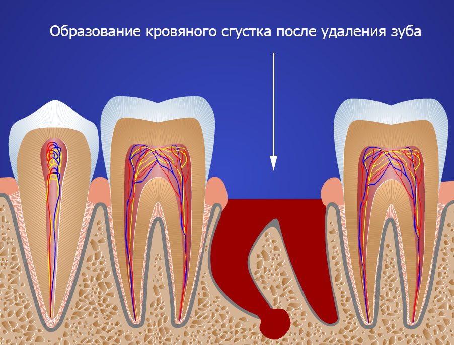 Что делать, если после удаления зуба болит десна. Как долго длится воспаление, и нормально ли это