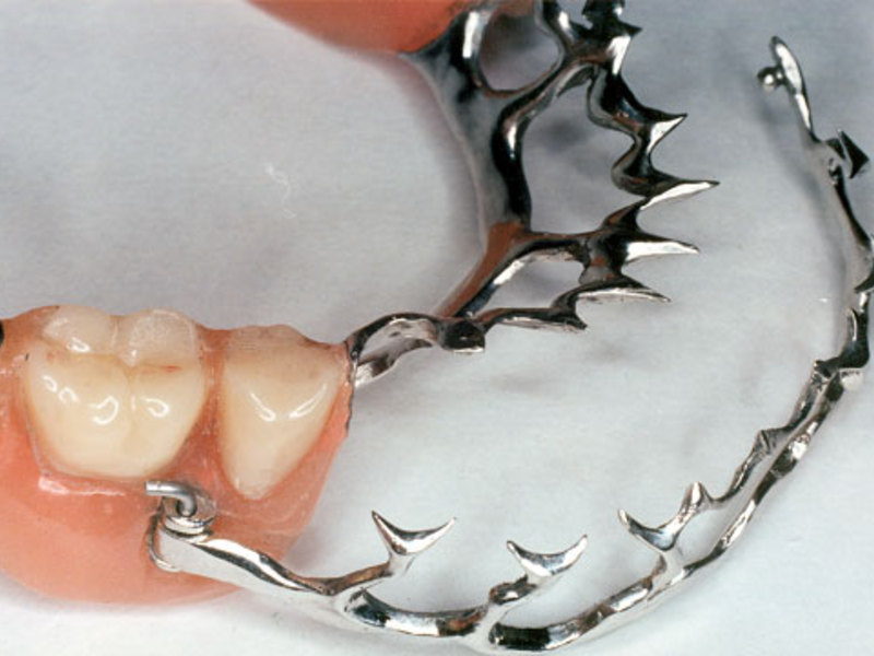 Особенности протезирования при пародонтозе и пародонтите. Можно ли вставить зубы при заболеваниях пародонта