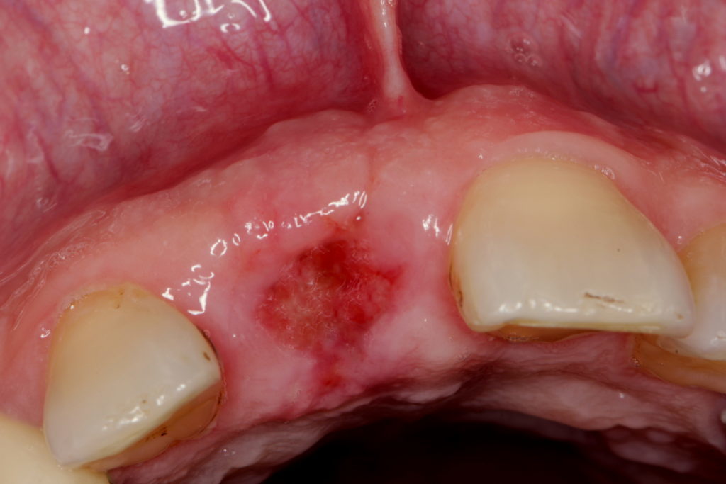 Применение препарата солкосерил для десен и послости рта в стоматологии. Заживляет и обезболивает