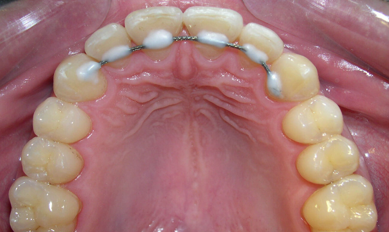 Особенности протезирования при пародонтозе и пародонтите. Можно ли вставить зубы при заболеваниях пародонта