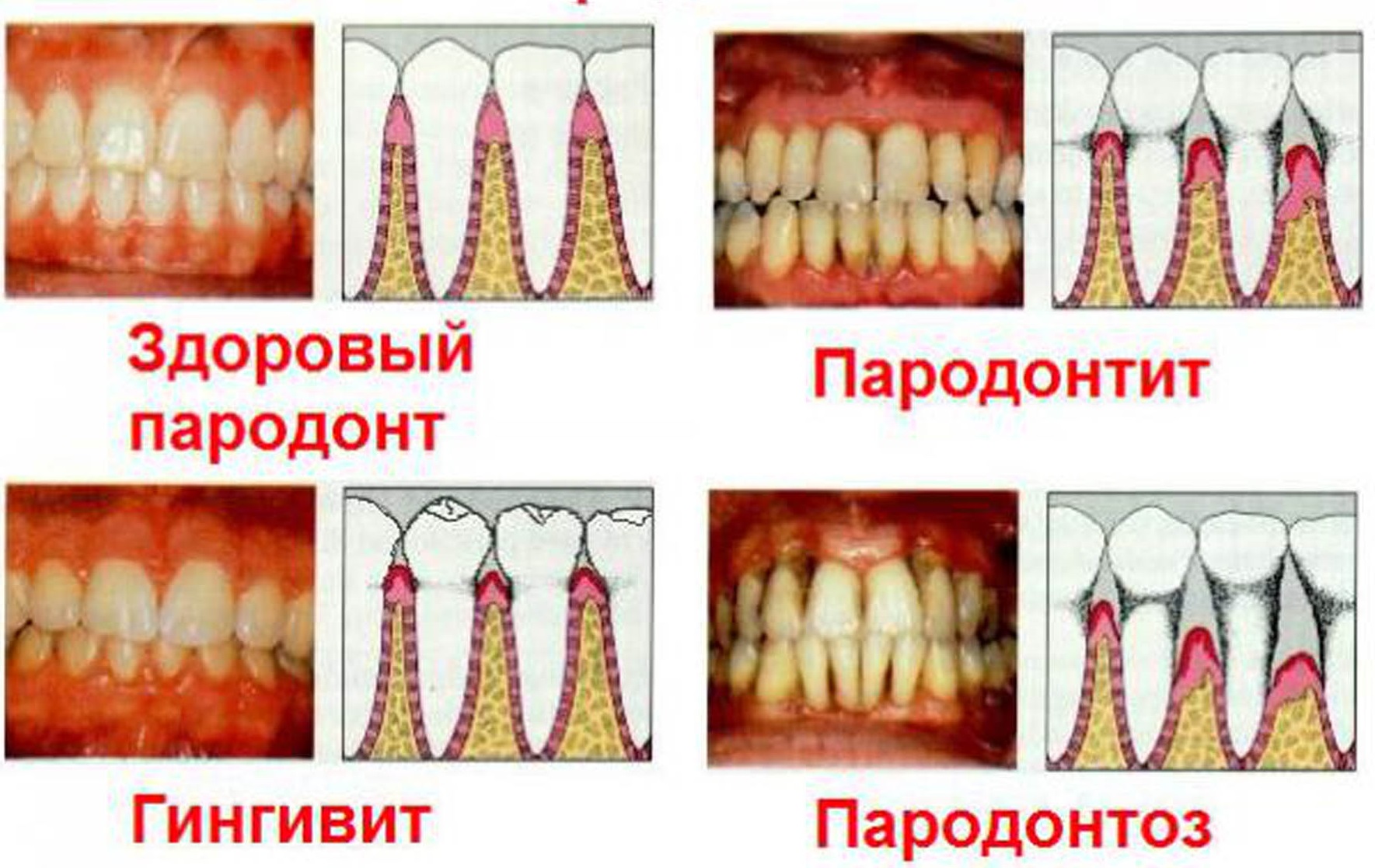 Что означает красная десна вокруг зуба у ребенка или у взрослого. Причины и лечение