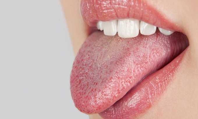 Один из последствий головных болей при панкреатите является сухость во рту