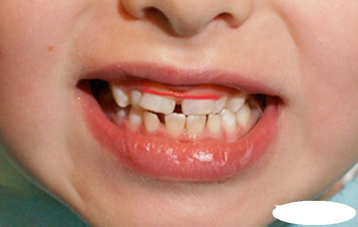 Как закрыть щель между зубами? Методы комплексного лечения диастемы зубов