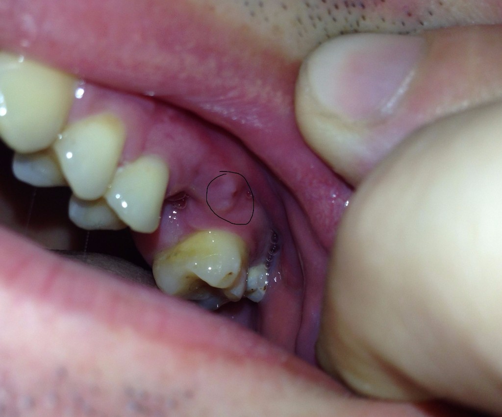 Что такое экзостоз в стоматологии: костный нарост на десне. Как происходит удаление