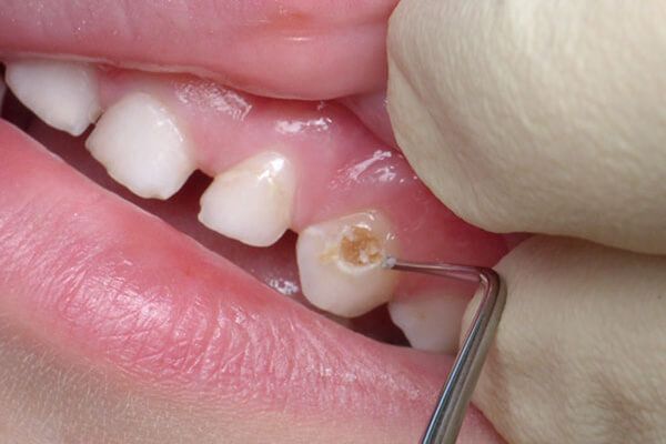 На поверхностной стадии - поражена эмаль зуба