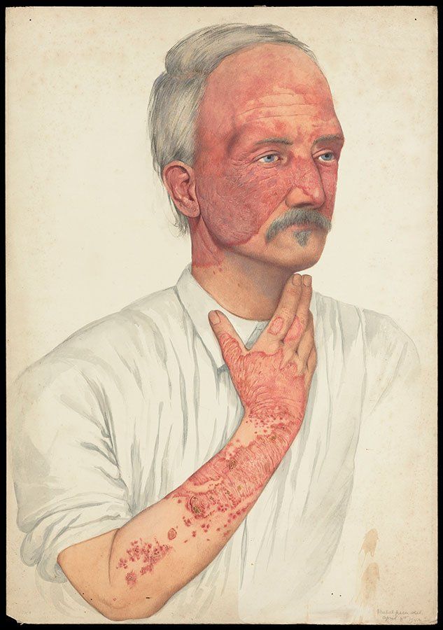 Туберкулез кожи