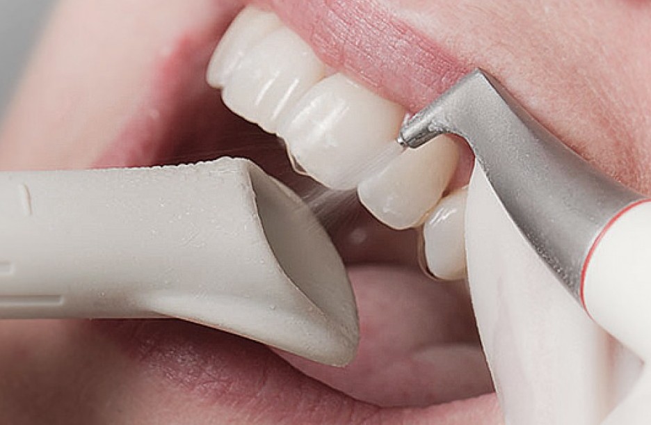 Какой способ отбеливания зубов самый щадящий и эффективный? Ищем самый безопасный метод