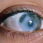 Дистрофия сетчатки глаза