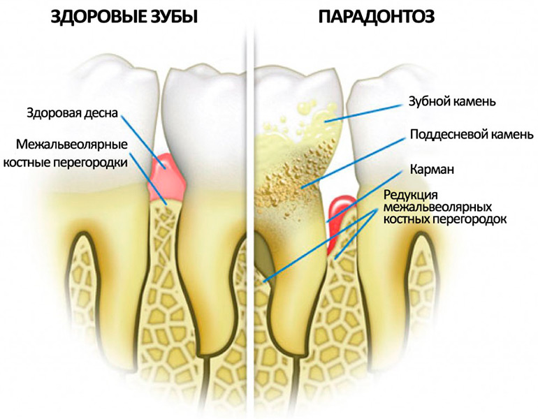 Какие существуют лечебные зубные пасты от пародонтоза? Делаем правильный выбор