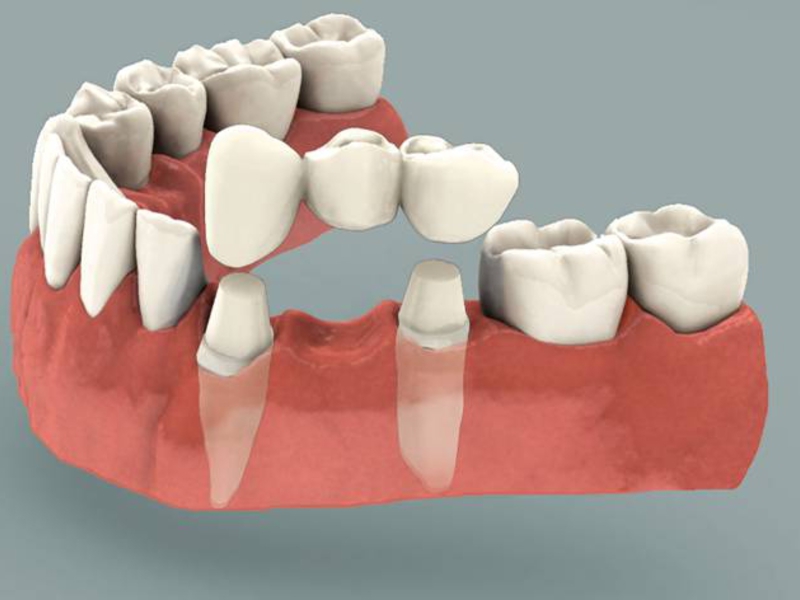 Что такое имплантация зубов и как она делается. Обзор методов вживления зубов