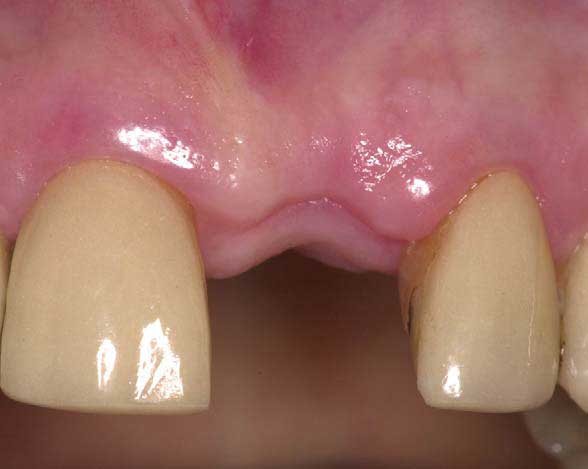 Важная процедура удаление молочных зубов у детей