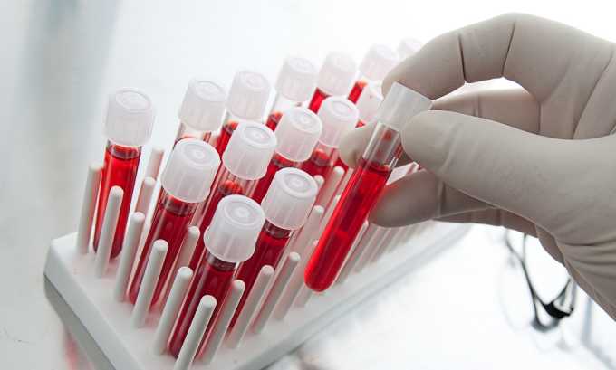 Общий анализ крови покажет воспаление в организме за счет повышенного числа лейкоцитов и увеличенной СОЭ