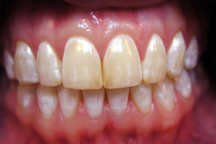 Что такое виниры на зубы? Делаем улыбку идеальной