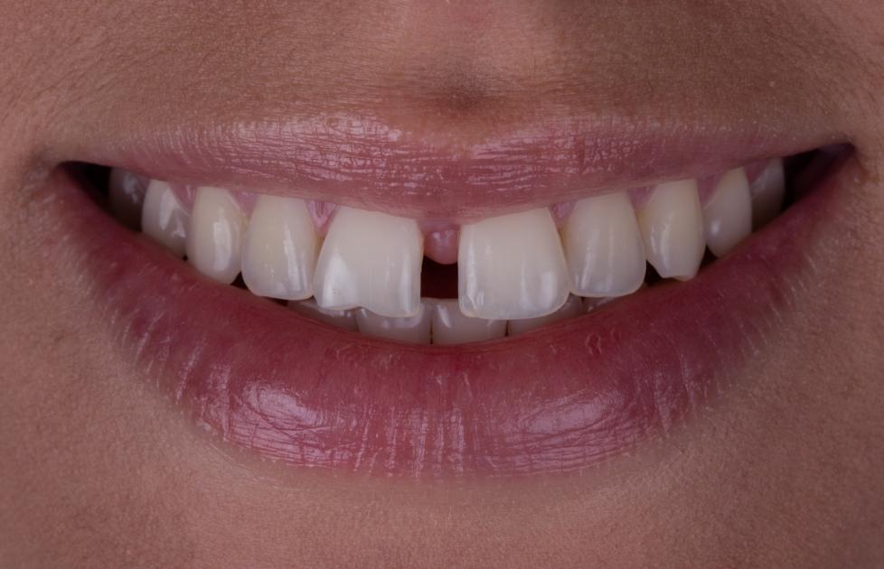 Как закрыть щель между зубами? Методы комплексного лечения диастемы зубов