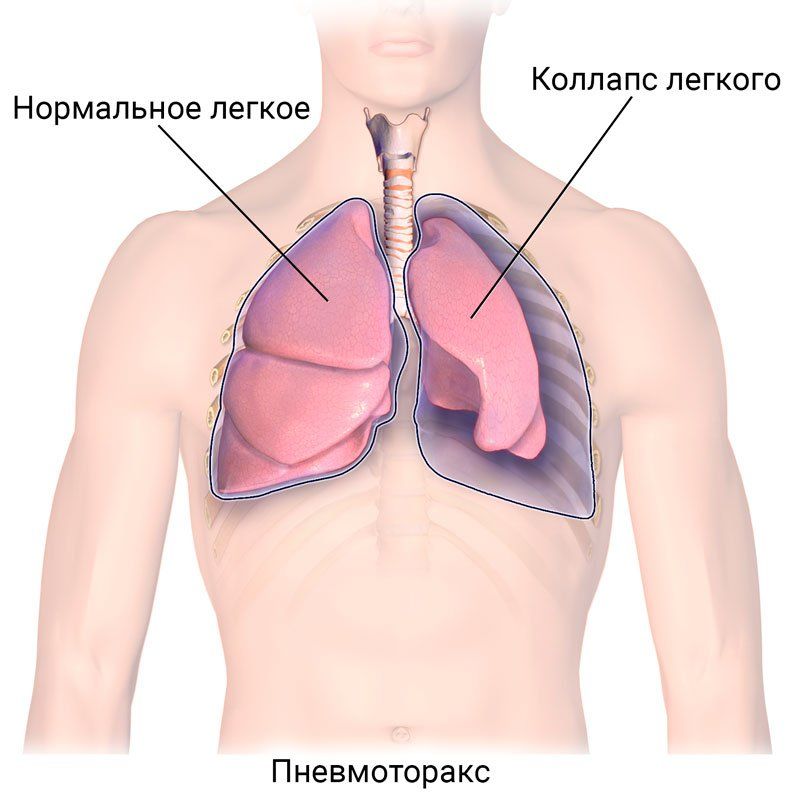 Клиническая картина открытого пневмоторакса