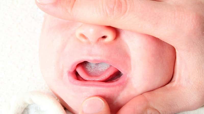 Использование Калгеля при стоматите и других заболеваниях полости рта у детей и взрослых