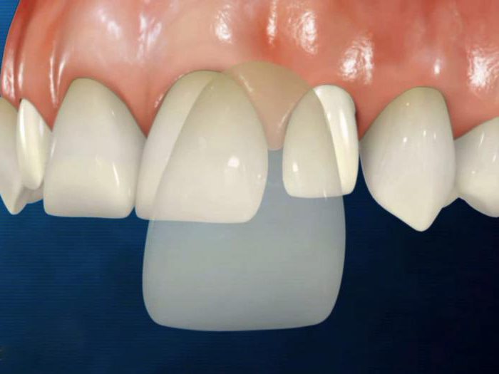 Что такое виниры на зубы? Делаем улыбку идеальной