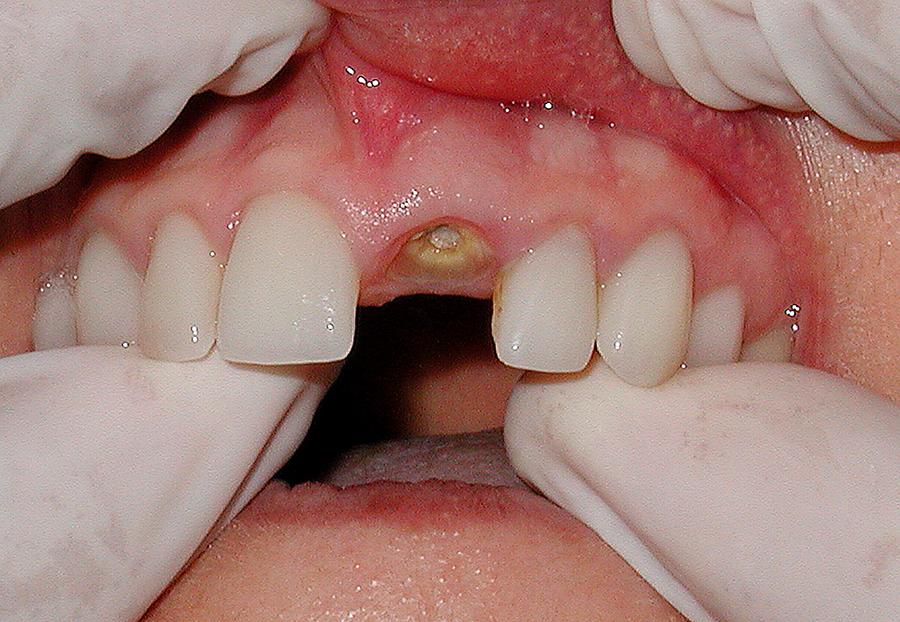 Лечение стоматита после удаления зуба. Виноват ли стоматолог