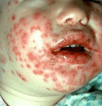 Чем опасен вирусный стоматит у детей симптомы и лечение