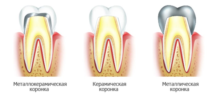 Причина воспаления десен под коронками thumbnail