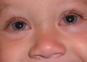 Глазные капли для детей от конъюктивита
