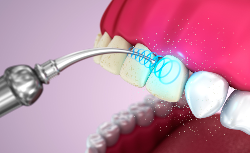 Что такое ультразвуковая чистка зубов. Эффективное отбеливание и удаление зубного камня