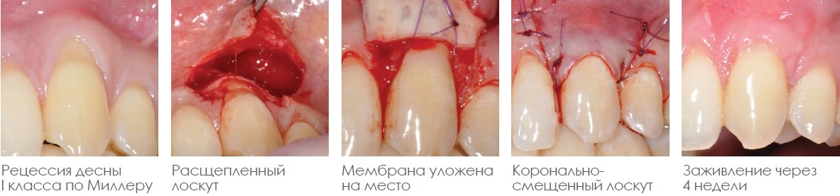 Зачем стоматологу скальпель: лоскутная операция при пародонтите