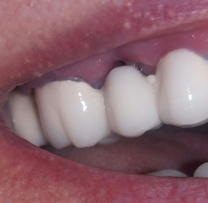 Почему может появиться черная точка на десне и почернеть зубы. Не доводите до рака
