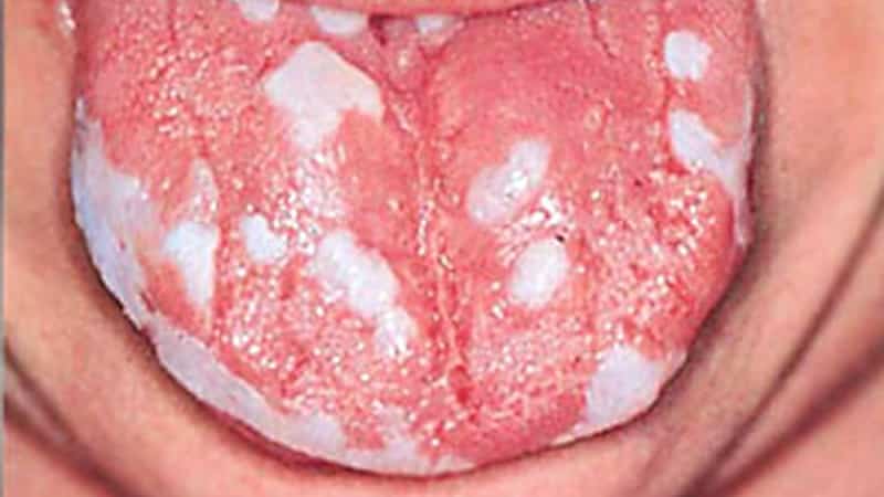 Симптомы и лечение кандидоза слизистой оболочки полости рта у взрослых. Какая у вас форма заболевания