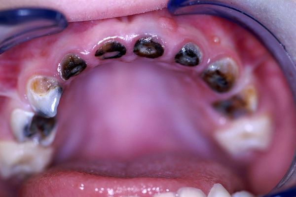 При образовании абсцесса зуб необходимо удалить