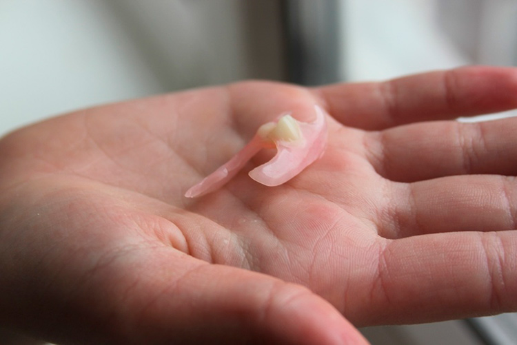 Что такое съемный зубной протез-бабочка на один зуб. Плюсы и минусы иммедиата
