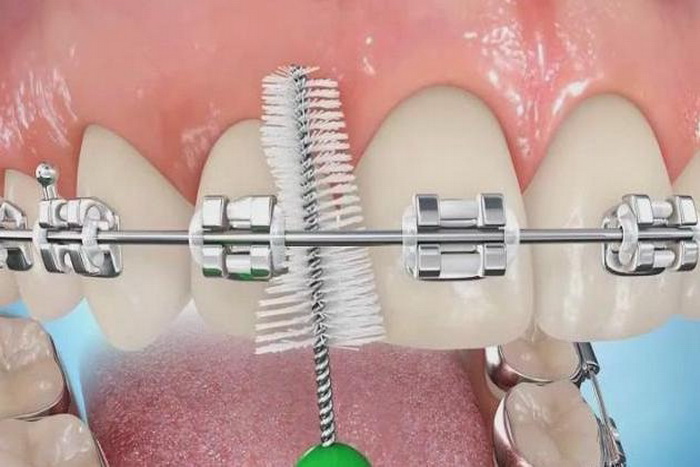 Как правильно чистить зубы с брекетами? Поможет ли делу гигиены зубная нить и специальная паста