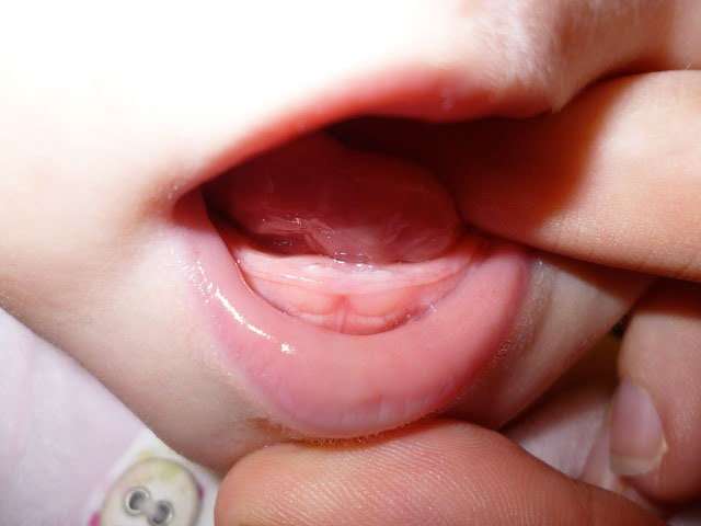 Использование Калгеля при стоматите и других заболеваниях полости рта у детей и взрослых