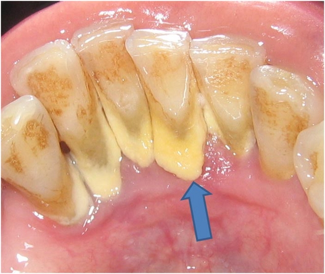 Ультразвук в стоматологии: применение аппарата Вектор для лечения пародонтита и других заболеваний десен