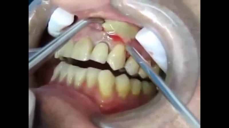 Как происходит удаление кисты зуба. Больно ли это