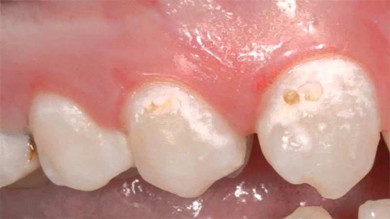 Почему появляются белые пятна на зубах у ребенка