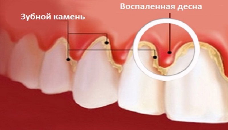Что такое коагуляция десны. Зачем в стоматологи делают прижигание слизистых тканей