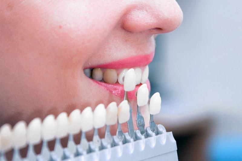 Как реставрировать передний зуб за одно посещение стоматолога? Помогут прямые виниры