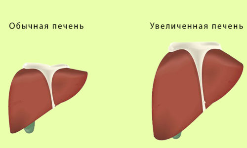 Билиарная форма панкреатита чаще всего возникает на фоне заболеваний печени