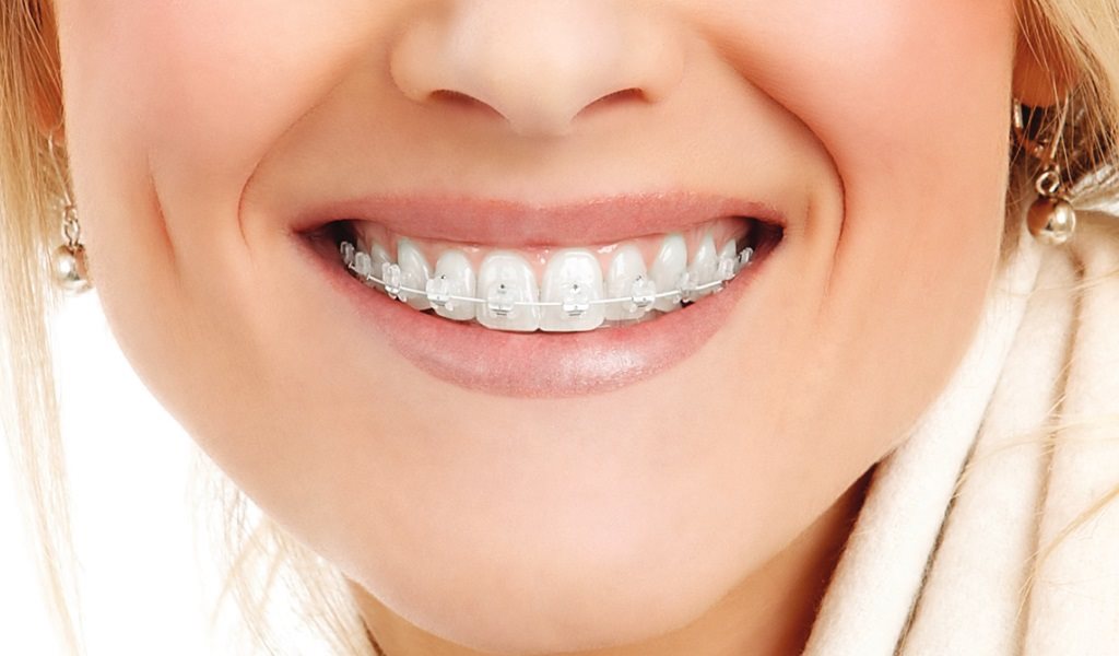 Как выбрать прозрачные брекеты на зубы? Плюсы и минусы систем из разных материалов