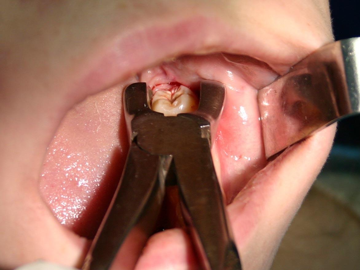 Страхи перед походом к стоматологу больно ли удалять зуб мудрости