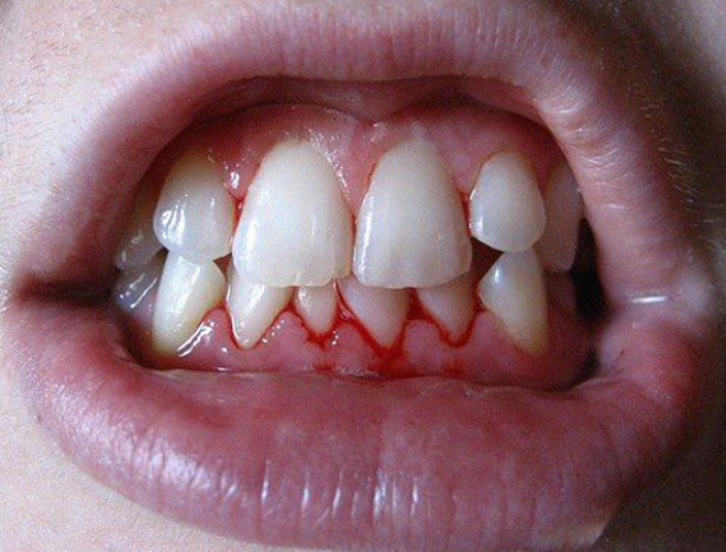 Не доводите дело до скальпеля! Комплексное лечение пародонтита у стоматолога и в домашних условиях
