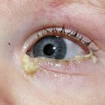 Лечение конъюнктивита глаз народными средствами