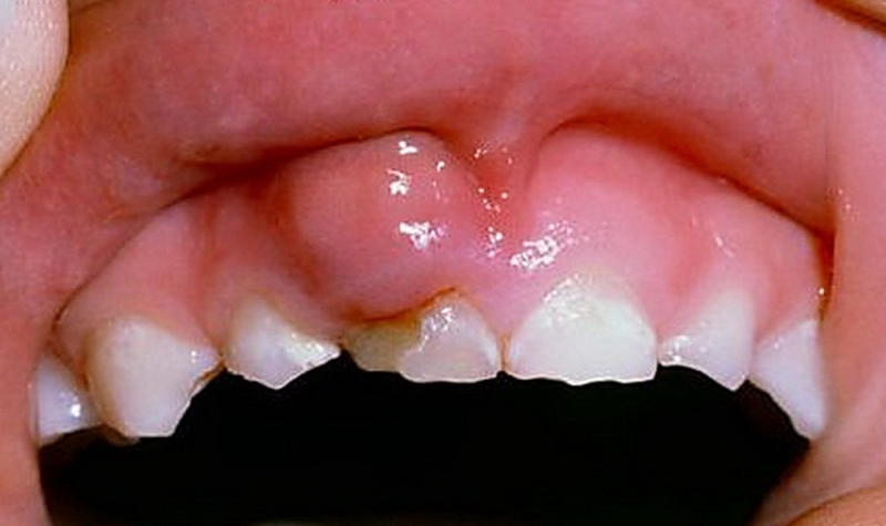 У ребенка периодонтит молочного зуба как избежать опасных последствий
