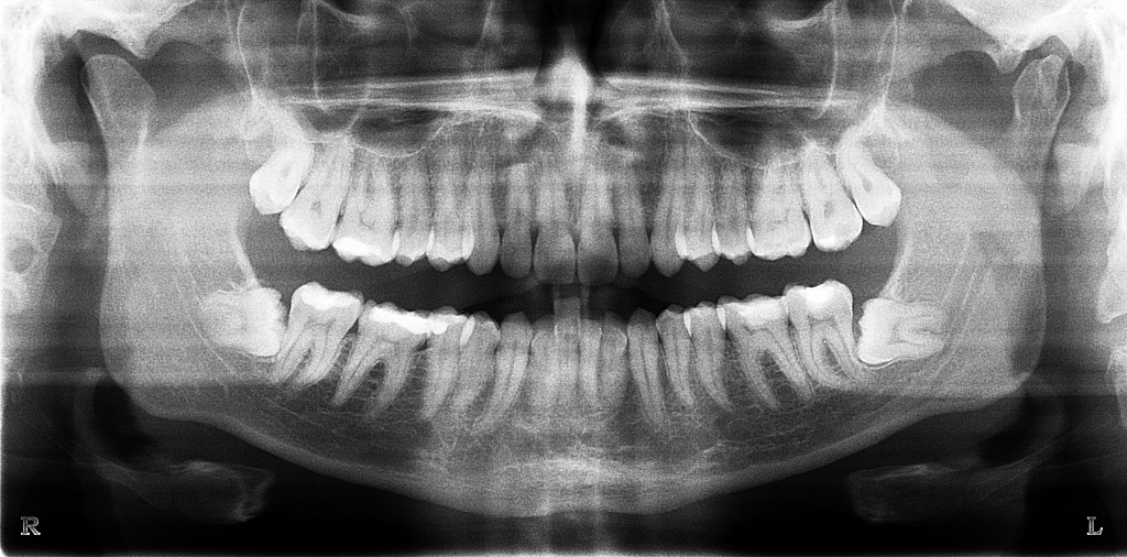 Лучше сделать 3d снимок зубов или панорамный? Чем вреднее облучаться в стоматологии