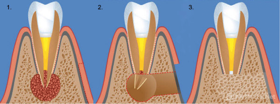 Как происходит удаление кисты зуба? Современные методы